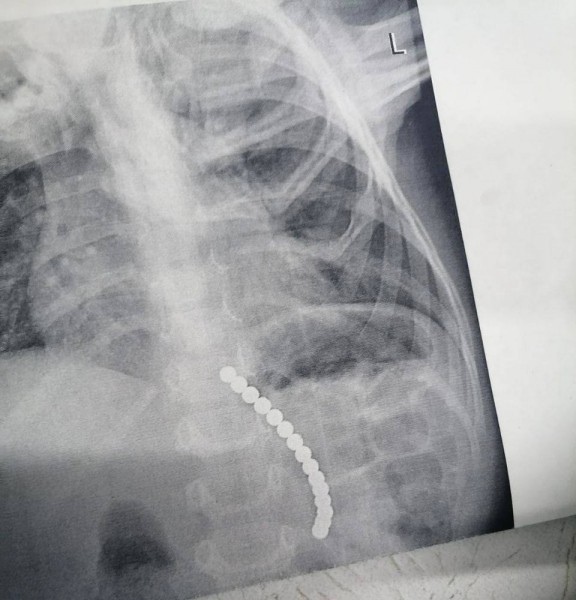 15 магнитов из желудка ребенка извлекли хирурги Оренбурга