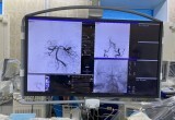 Оренбургские рентген-хирурги выполнили операцию по удалению тромбов из базилярной артерии