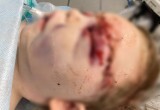 В Оренбурге врачи провели сложную операцию ребенку, пострадавшему от удара копытом жеребенка
